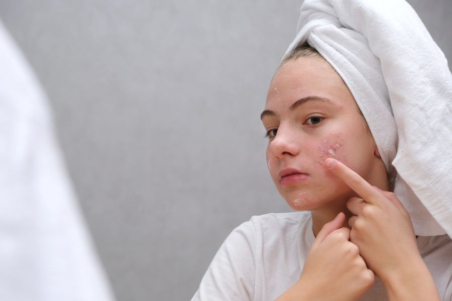 Bôi thuốc trị mụn sau khi đã rửa sạch tay