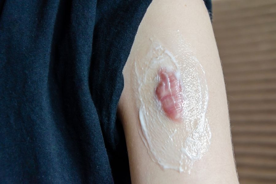 Dùng mỡ trăn trị sẹo có tốt và hiệu quả như lời đồn? 2 Sử dụng các loại kem bôi trị sẹo có chiết xuất mỡ trăn để giảm bớt mùi khó chịu