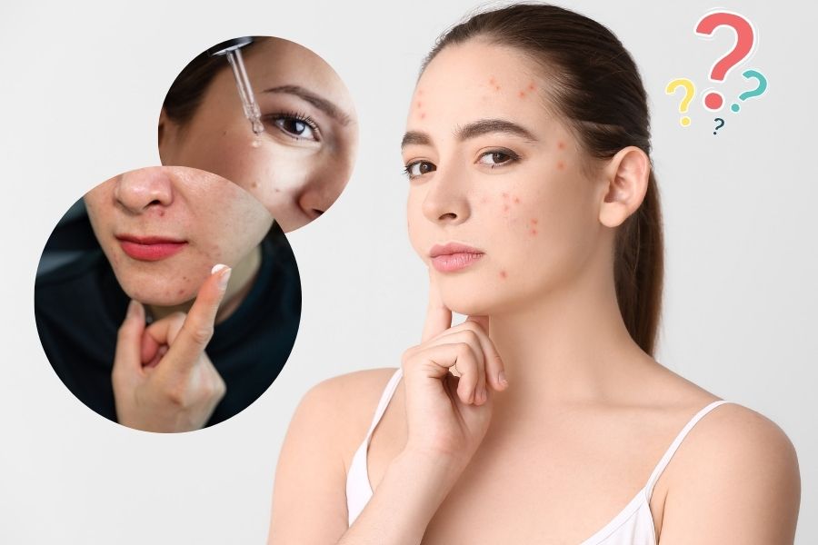 Kem trị mụn và serum chỉ có khả năng hỗ trợ điều trị mụn