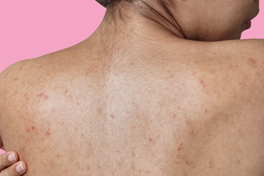 Sử dụng thuốc điều trị viêm nang lông