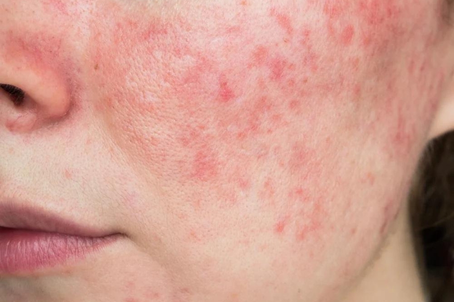 Viêm da tiếp xúc kích thích khi dùng kem chống nắng Viêm da tiếp xúc kích thích khi dùng kem chống nắng