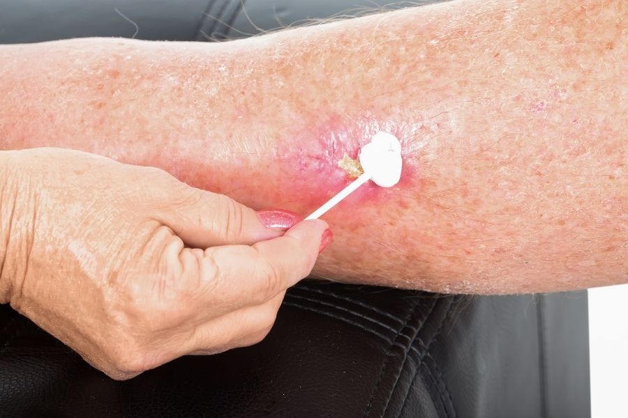 Một số tác hại của mỡ trăn trị sẹo không đúng cách tác hại của mỡ trăn trị sẹo