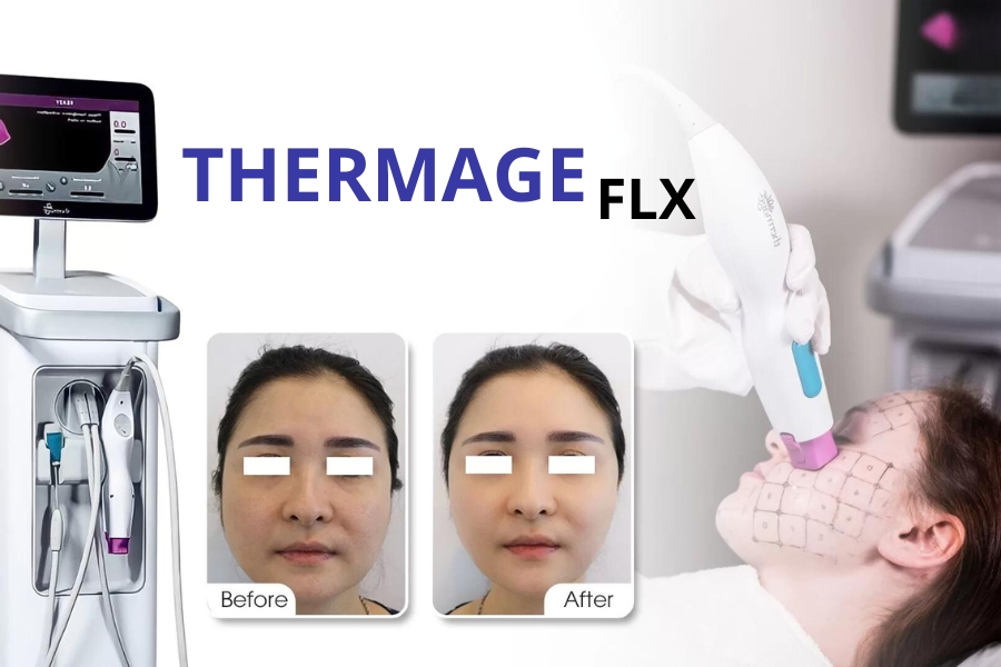 Ưu điểm của công nghệ THERMAGE FLX là gì?