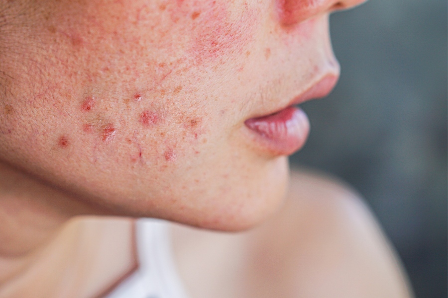 Da mặt bị dị ứng mỹ phẩm