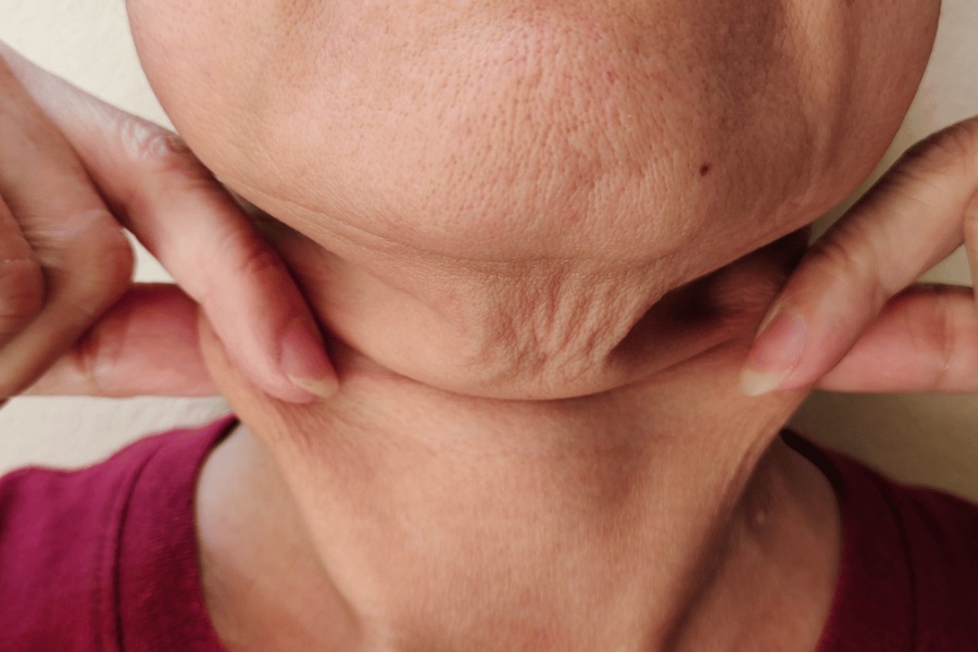 Da chảy xệ chùng nhão: Nguyên nhân do đâu, làm sao để cải thiện? 2 da chảy xệ là gì