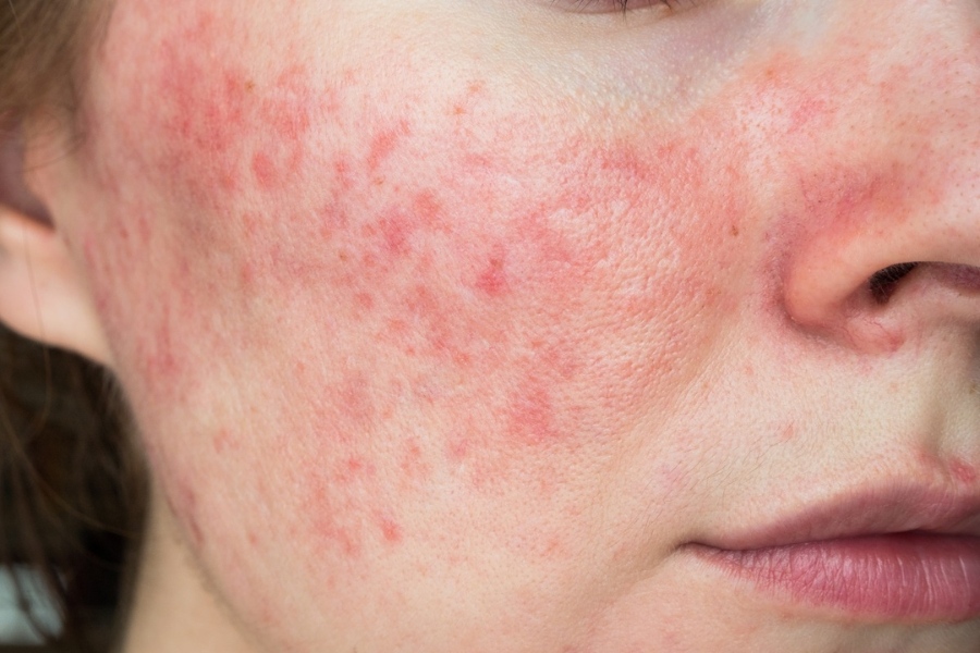 Da mặt bị dị ứng mỹ phẩm
