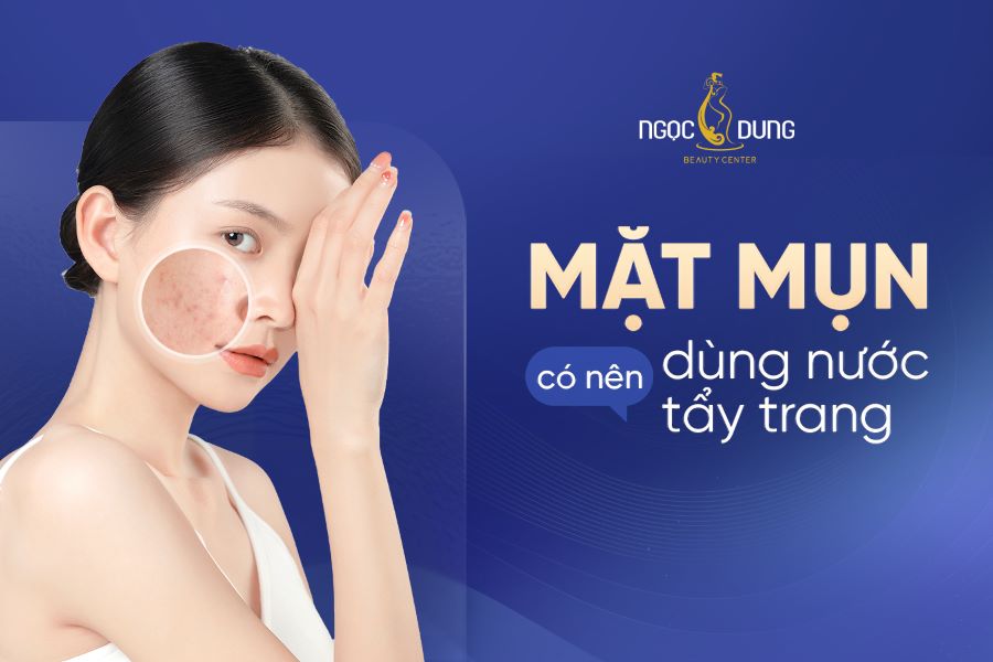 Mặt mụn có nên dùng nước tẩy trang? Cách dùng đúng chuẩn