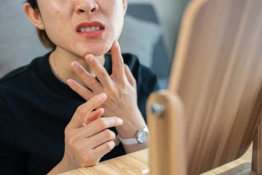 Mụn dị ứng là mụn như thế nào? Mụn dị ứng là mụn như thế nào?