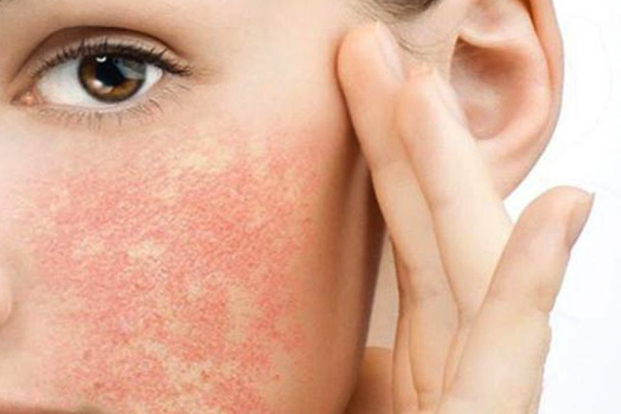 da bị dị ứng mỹ phẩm nổi ban đỏ 