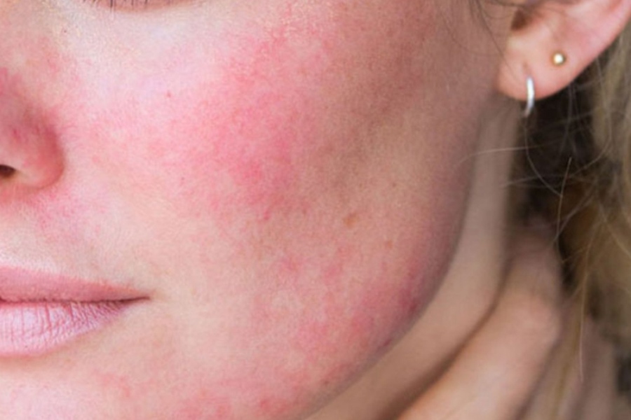Da bị ửng đỏ, nóng rát do bị dị ứng với mỹ phẩm