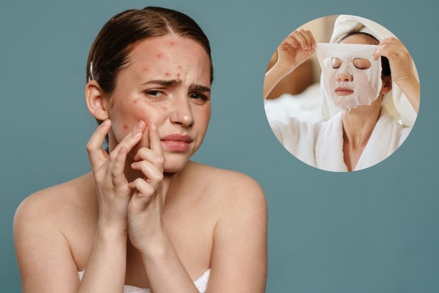 Thời điểm lý tưởng để đắp mặt nạ là từ 2-3 tiếng sau khi nặn mụn Thời điểm lý tưởng để đắp mặt nạ là từ 2-3 tiếng sau khi nặn mụn