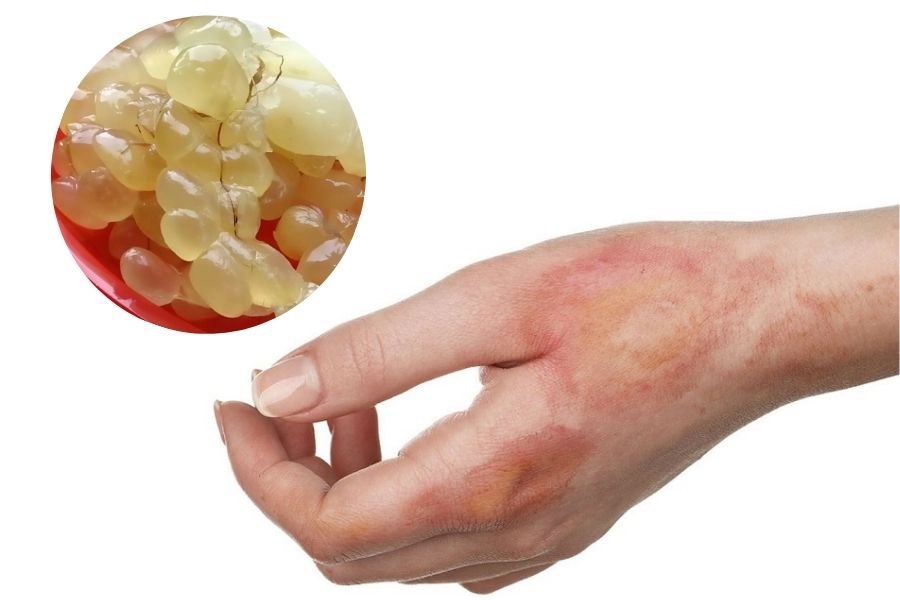 Mỡ trăn có khả năng hỗ trợ trị sẹo bỏng Mỡ trăn có khả năng hỗ trợ trị sẹo bỏng