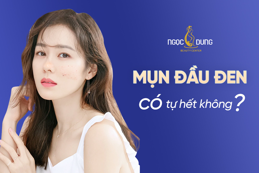 Mụn đầu đen có tự hết được không? Cùng chuyên gia tại Ngọc Dung tìm hiểu ngay