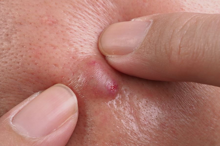 Mụn bọc mủ là một loại mụn viêm sưng to, có chứa mủ bên trong