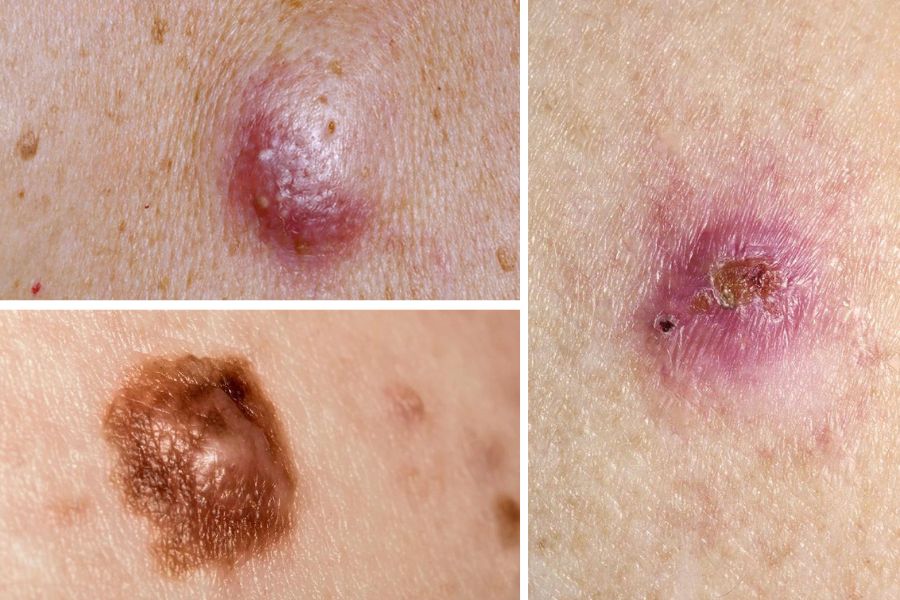 Không nên điều trị tự nặn mụn ác tính tại nhà