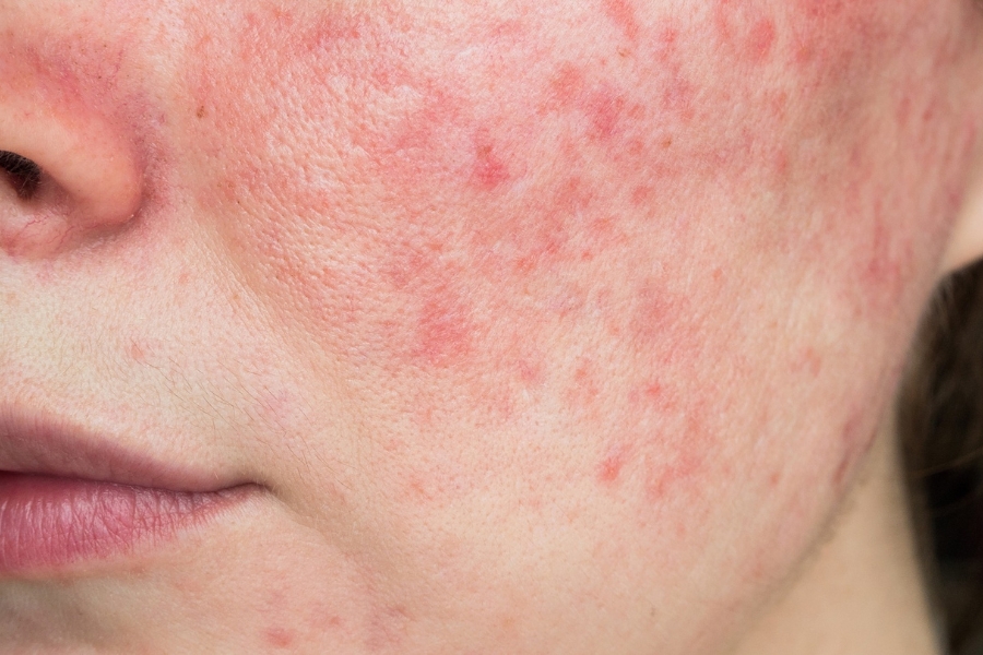 Mụn đỏ hai bên má nổi nhiều do sừng hóa, tích tụ bã nhờn