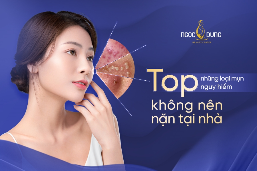 TOP những loại mụn nguy hiểm không nên nặn tại nhà