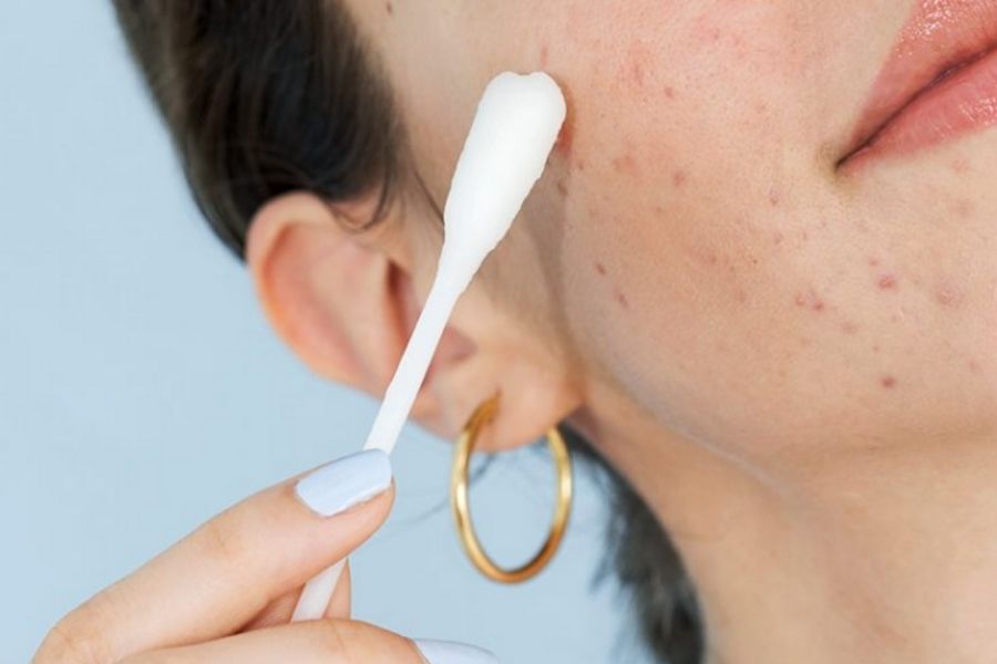 Povidine thuốc đỏ có trị mụn được không? Có tốt không? 2 Sát khuẩn cho da bằng thuốc đỏ sau khi trị mụn