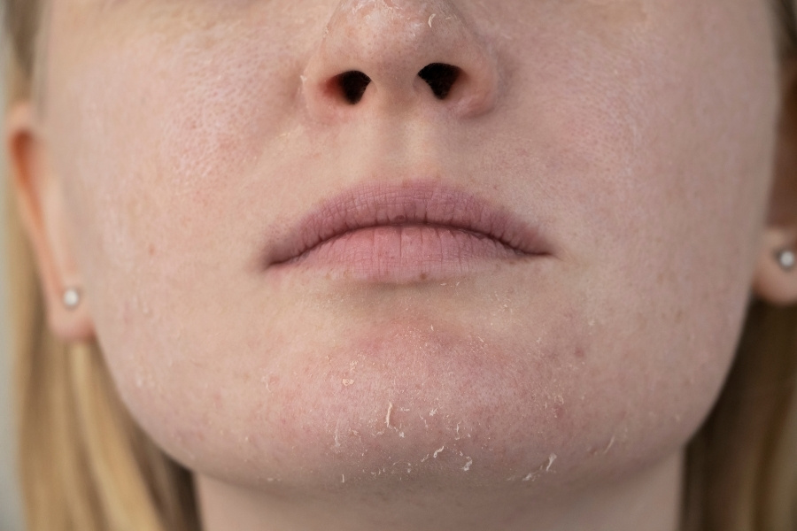 Khi bôi kem đánh răng lên mụn để qua đêm bạn sẽ thấy da bị khô hơn, mỏng hơn và bong tróc thành từng mảng Khi bôi kem đánh răng lên mụn để qua đêm bạn sẽ thấy da bị khô hơn, mỏng hơn và bong tróc thành từng mảng