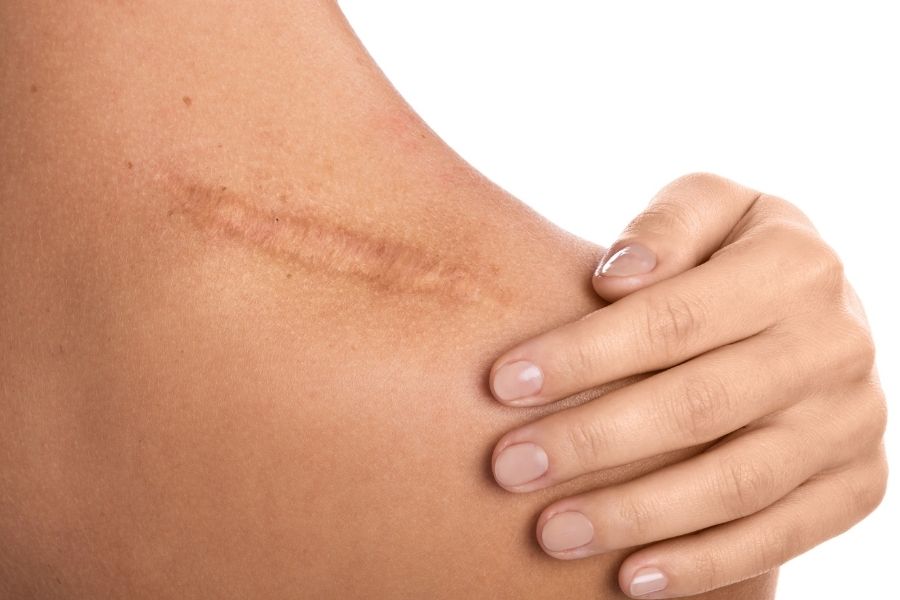 Mỡ trăn trị sẹo thâm được hay không còn dựa vào cơ địa và tình trạng sẹo Mỡ trăn trị sẹo thâm