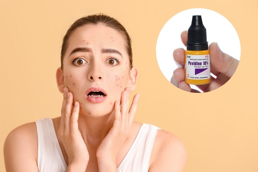 Thuốc đỏ có trị mụn được không? Câu trả lời của chuyên gia là KHÔNG Thuốc đỏ có trị mụn được không? Câu trả lời của chuyên gia là KHÔNG