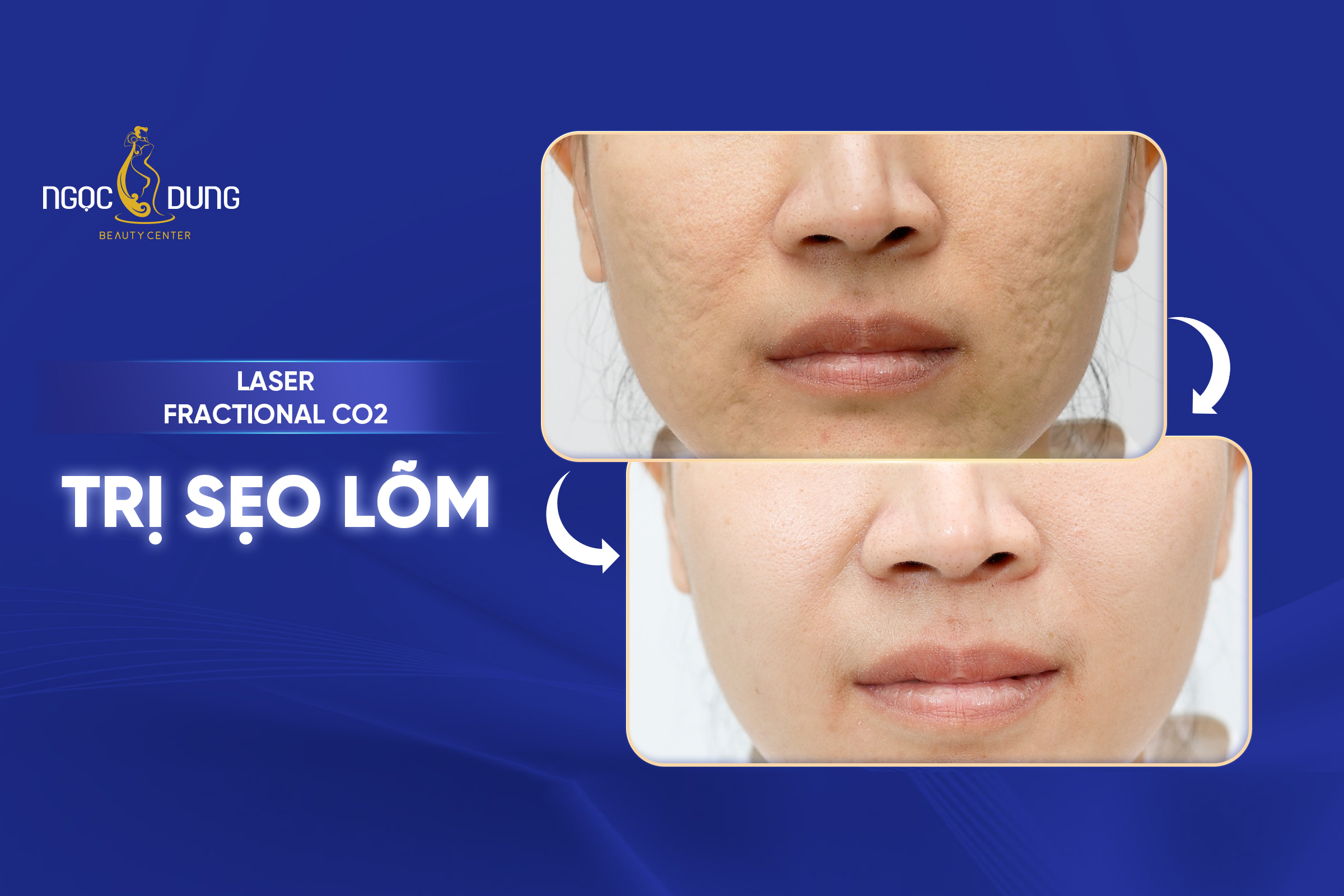 Trị sẹo lõm lâu năm Ngọc Dung