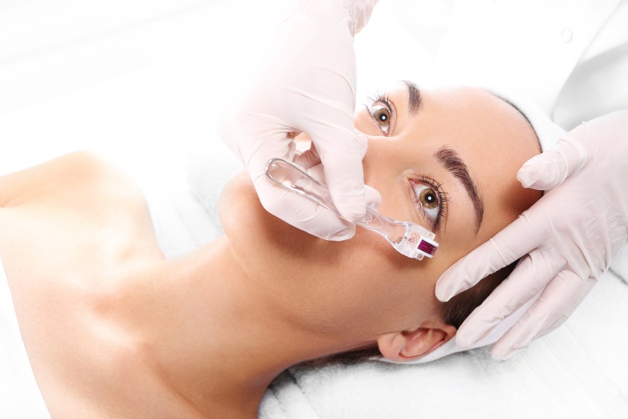 Lăn kim trị sẹo rỗ lâu năm