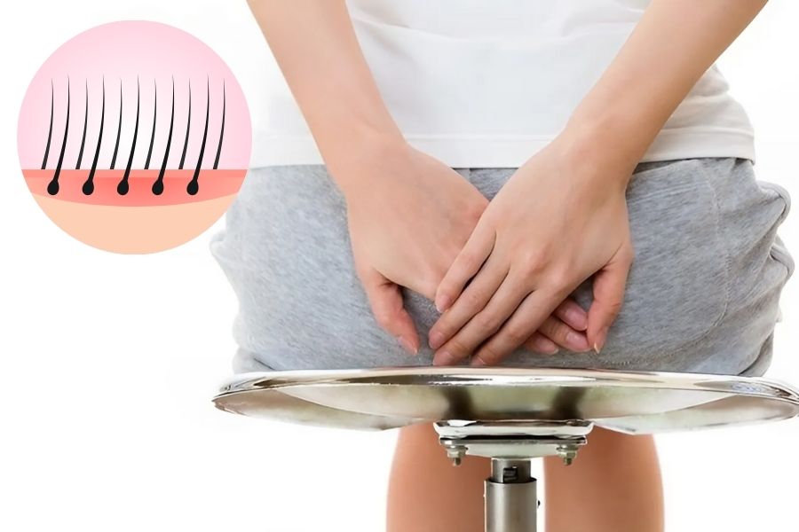 Triệt lông hậu môn: Không đau, an toàn, hiệu quả vượt trội 2 Lông mọc ở hậu môn là điều hoàn toàn bình thường không ảnh hưởng đến sức khỏe