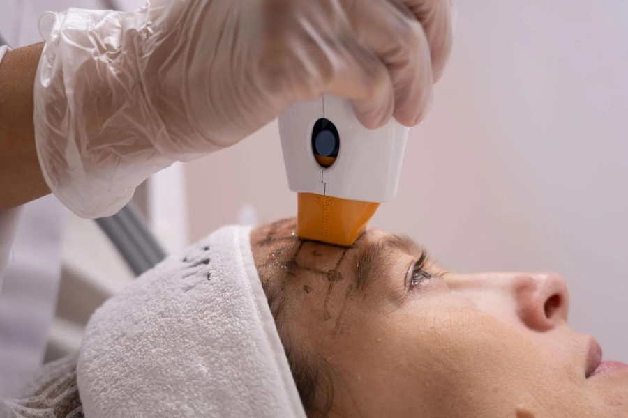 Công nghệ THERMAGE FLX giá bao nhiêu?