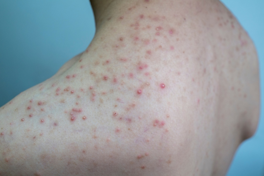 Viêm lỗ chân lông lưng