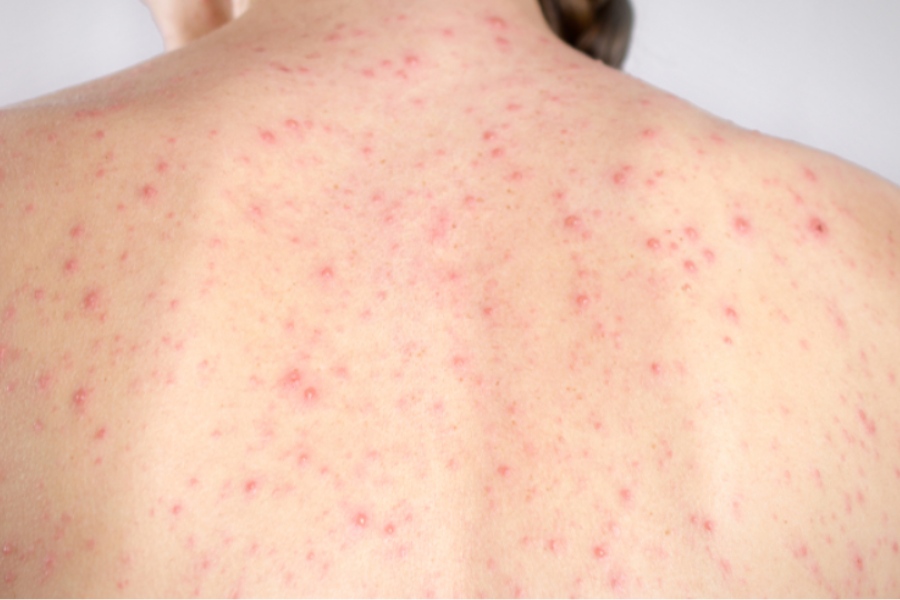 Hình ảnh viêm nang lông ở lưng