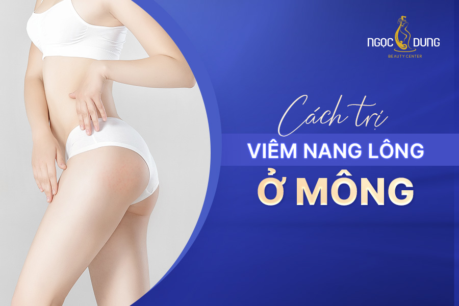 viêm nang lông ở mông