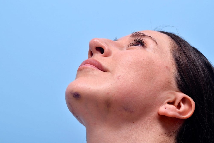 Tác hại biến chứng khi tiêm tế bào gốc trẻ hóa da tại cơ sở kém uy tín