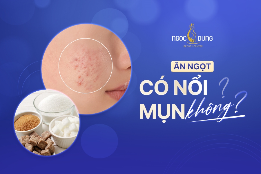 Ăn ngọt có nổi mụn không? Bí quyết ăn đồ ngọt hạn chế mụn