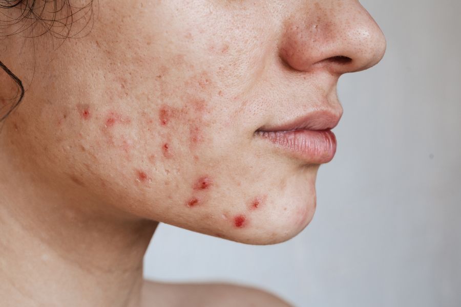 Nên hiểu rõ mức độ nghiêm trọng và tần suất của mụn trước khi tẩy tế bào chết Nên hiểu rõ mức độ nghiêm trọng và tần suất của mụn trước khi tẩy tế bào chết