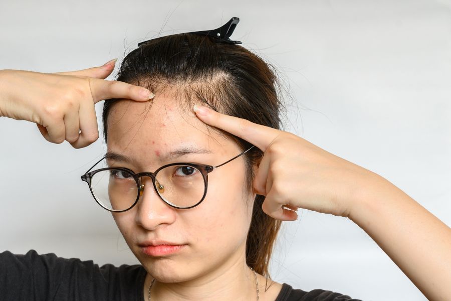 Một số nguyên nhân gây hình thành mụn đầu đen ở trán