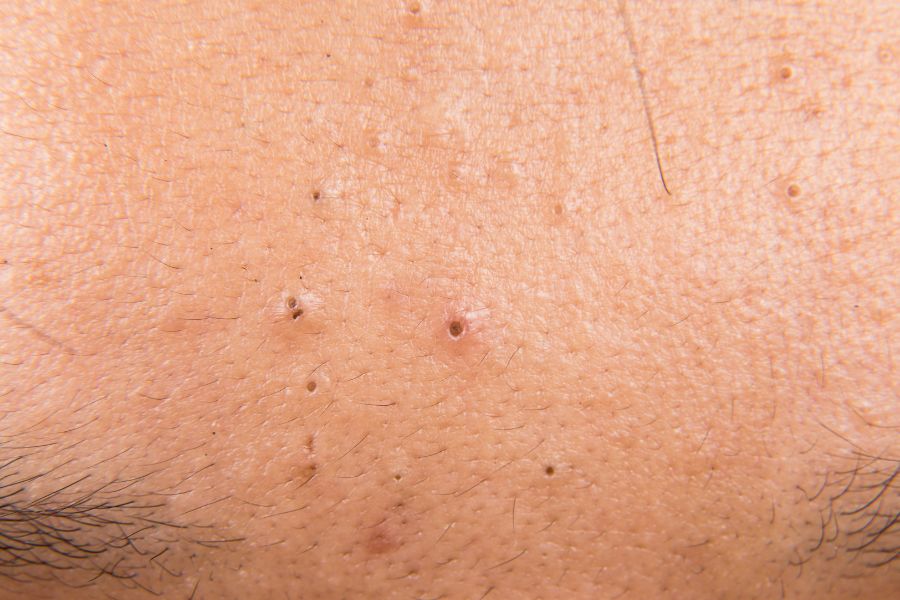 Mụn đầu đen ở trán là những nốt mụn nhỏ li ti, có kích thước nhỏ, xuất hiện ở dạng chấm tròn