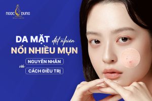 Da mặt đột nhiên nổi nhiều mụn: Nguyên nhân, cách khắc phục