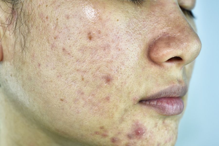 Da bị nhiễm hóa chất khiến mụn viêm xuất hiện ồ ạt là trường hợp không nên tẩy tế bào chết Da bị nhiễm hóa chất khiến mụn viêm xuất hiện ồ ạt là trường hợp không nên tẩy tế bào chết