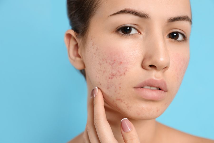 Phát ban mụn trứng cá ảnh hưởng tiêu cực đến tâm lý, khiến người bệnh lo lắng, tự ti