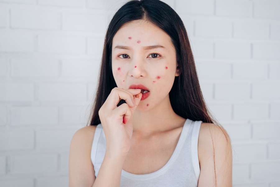 Thuốc trị mụn nếu được kê đơn và uống đúng theo chỉ định của bác sĩ sẽ không ảnh hưởng đến sức khỏe Thuốc trị mụn nếu được kê đơn và uống đúng theo chỉ định của bác sĩ sẽ không ảnh hưởng đến sức khỏe