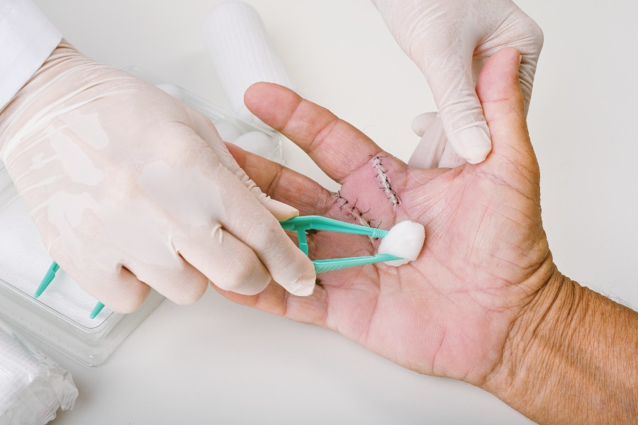 Sẹo lồi tự mọc được không? Làm sao để xóa sẹo lồi hiệu quả 10 width=