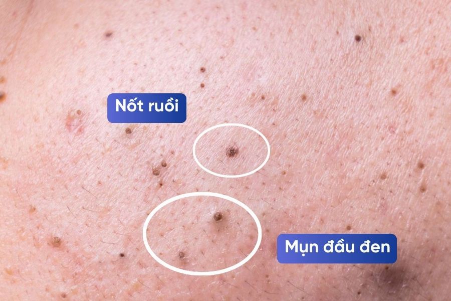 Từ bản chất của mụn đầu đen và nốt ruồi, có thể khẳng định rằng mụn đầu đen để lâu không bao giờ trở thành nốt ruồi. Từ bản chất của mụn đầu đen và nốt ruồi, có thể khẳng định rằng mụn đầu đen để lâu không bao giờ trở thành nốt ruồi.