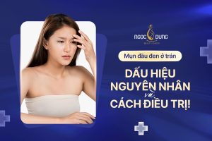 Mụn đầu đen ở trán: Nguyên nhân và cách điều trị dứt điểm