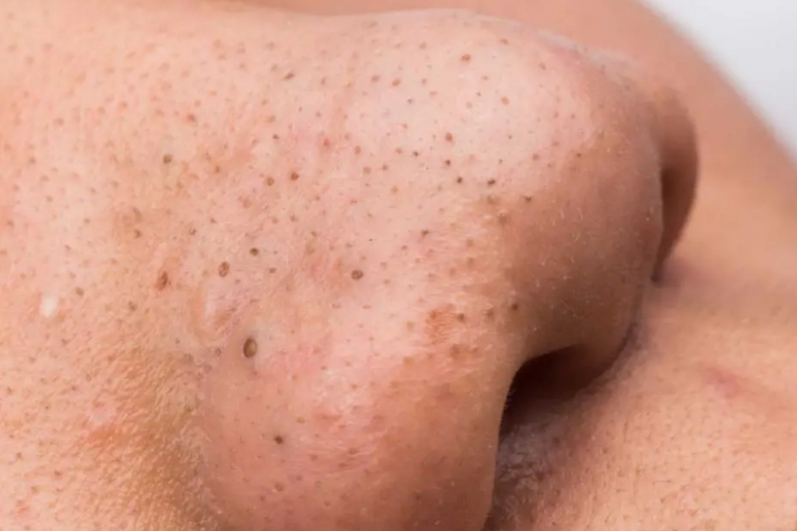 Với những đặc điểm nhận diện, không ít người lo ngại, băn khoăn rằng liệu mụn đầu đen có thành nốt ruồi không Với những đặc điểm nhận diện, không ít người lo ngại, băn khoăn rằng liệu mụn đầu đen có thành nốt ruồi không