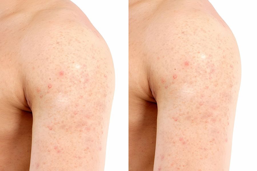 Một số loại mụn bắp tay thường gặp Một số loại mụn bắp tay thường gặp