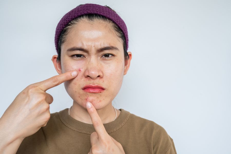 Viêm nhiễm kéo dài do mụn có thể gây tổn thương đến các mô da, để lại sẹo