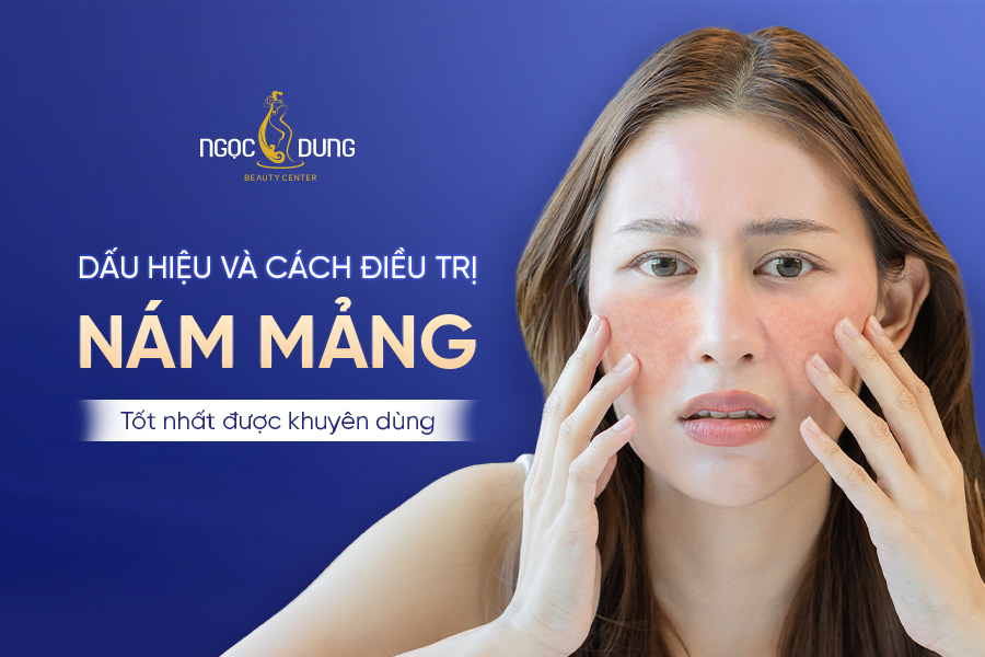 Nám mảng là gì? Nguyên nhân, cách điều trị nám mảng tốt nhất
