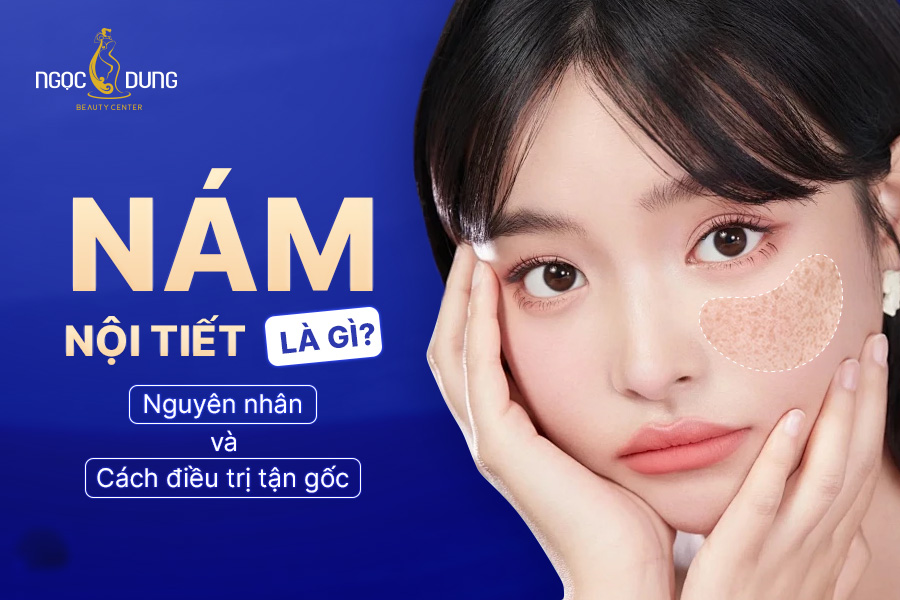 Nám nội tiết là gì? Nguyên nhân và cách điều trị nám da do nội tiết