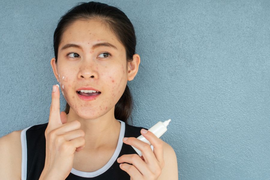 Bôi thuốc ngoài da giúp điều trị mụn đầu đen ở trán hiệu quả
